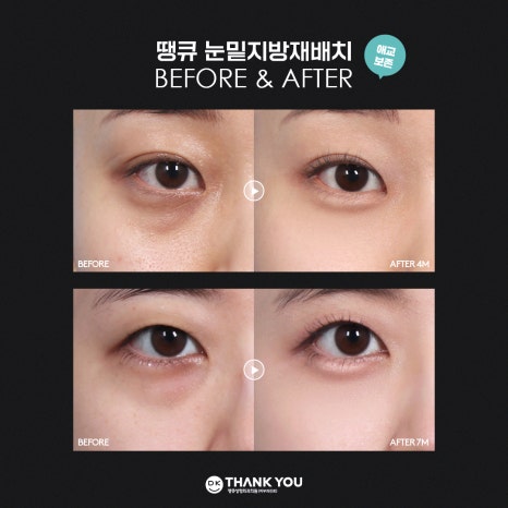 눈밑지방재배치잘하는병원 땡큐만의 특별한 노하우! 관련 이미지 8