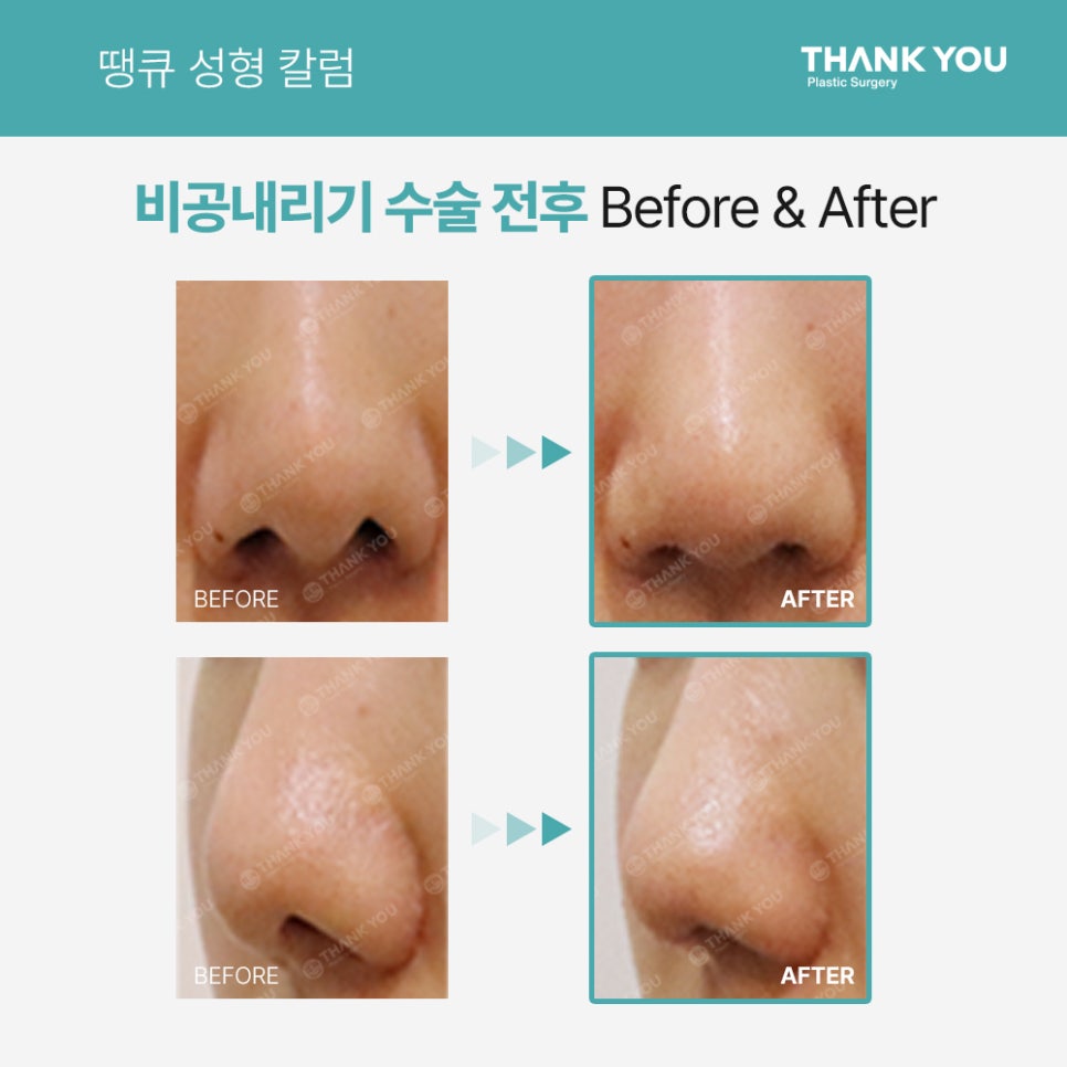 코성형, 비공내리기 수술이란? [콧구멍 잘 보이는 용코 개선] 관련 이미지 4