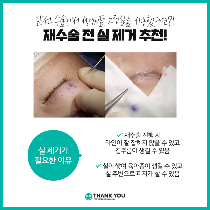 눈재수술전후 만족스러운 차이를 만들고 싶다면?! 관련 이미지 6