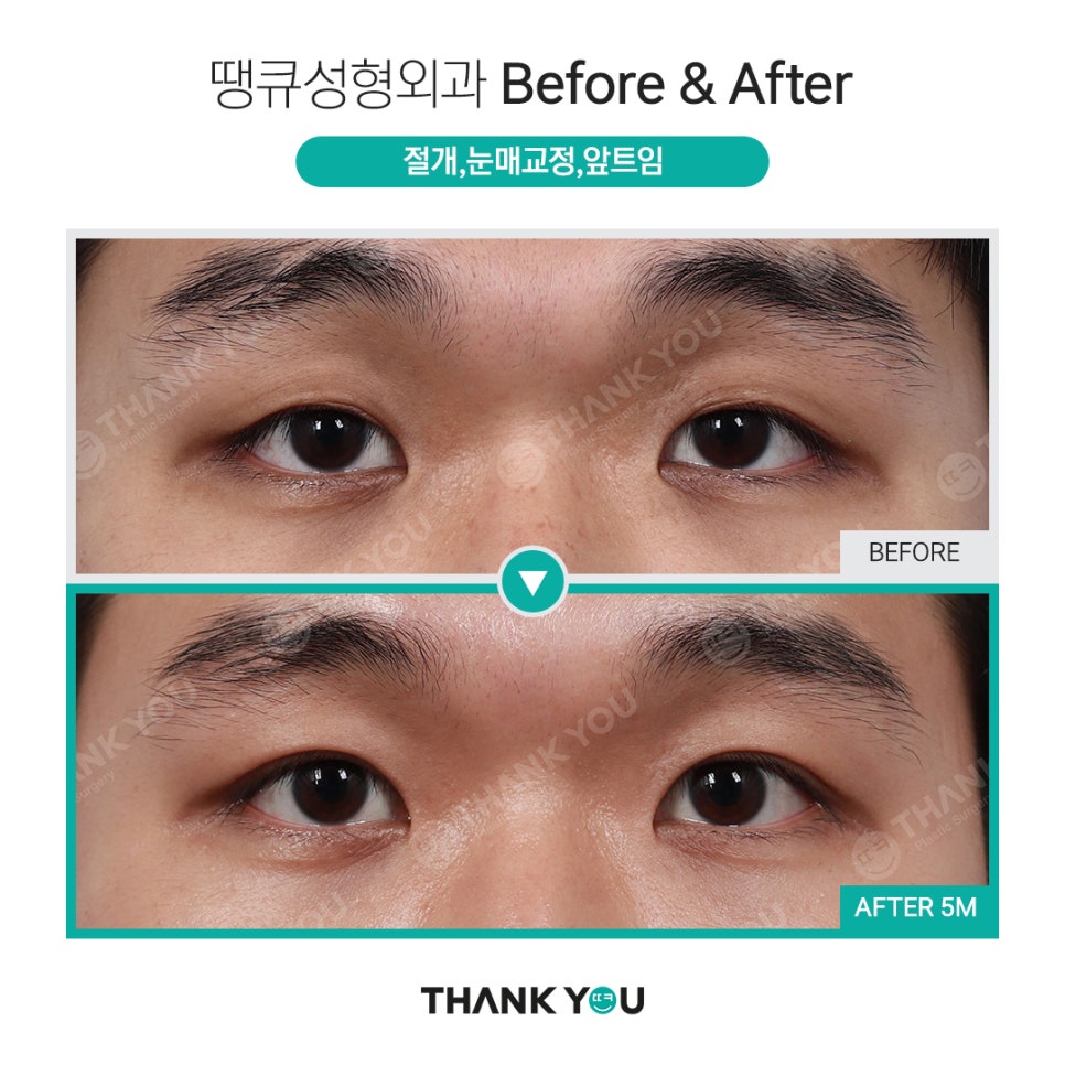 [남자 쌍수후기?] 망하기 싫으면 꼭 보세요! 관련 이미지 21