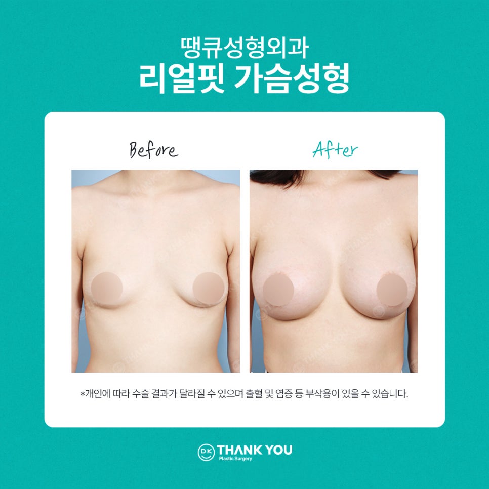 땡큐성형외과 멘토가슴성형 이벤트✨ 관련 이미지 7
