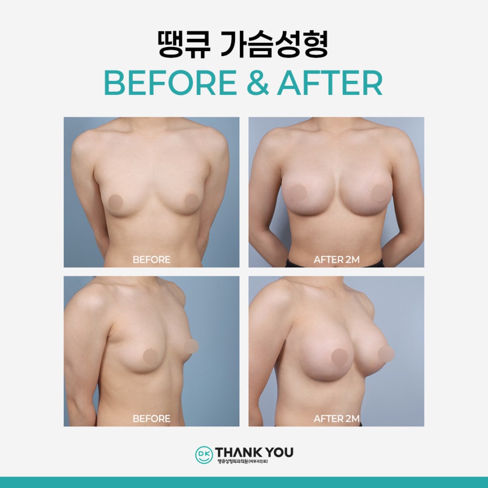 가슴보형물수술 vs 가슴 지방이식, 내게 적합한 선택은? 관련 이미지 12