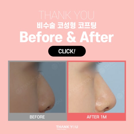 비수술코성형 실리프팅으로하는 코프팅 관련 이미지 17