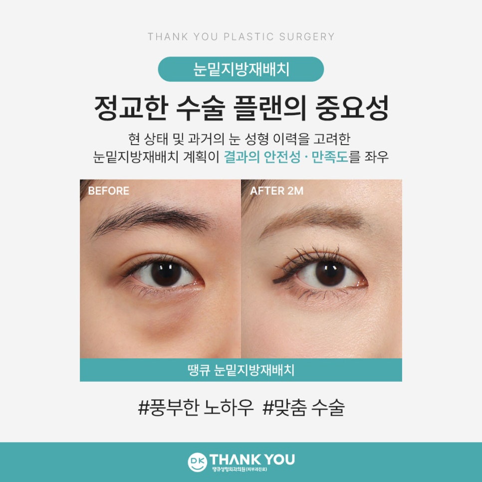 눈트임수술을 이미 했다면, 눈밑지 수술해도 괜찮을까?! 관련 이미지 7
