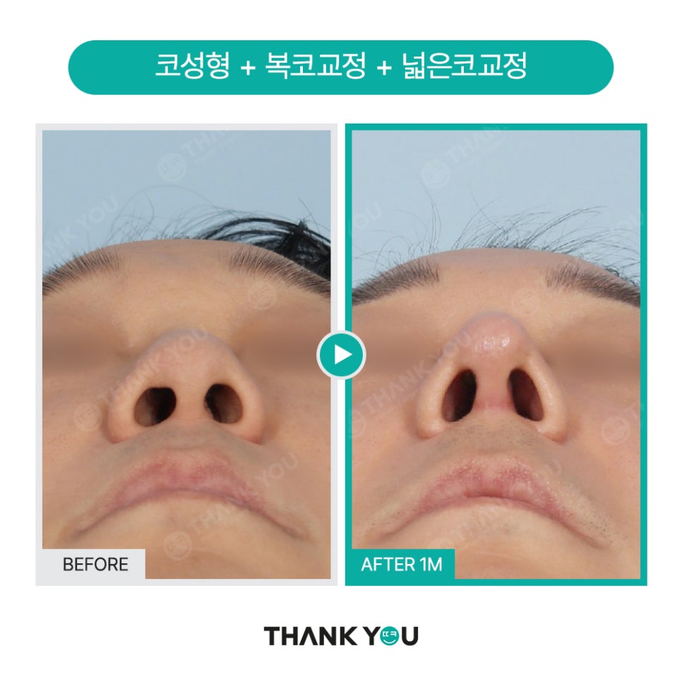 신논현역 성형외과, 남자 휜코성형, 매부리코 성공 포인트는? 관련 이미지 16