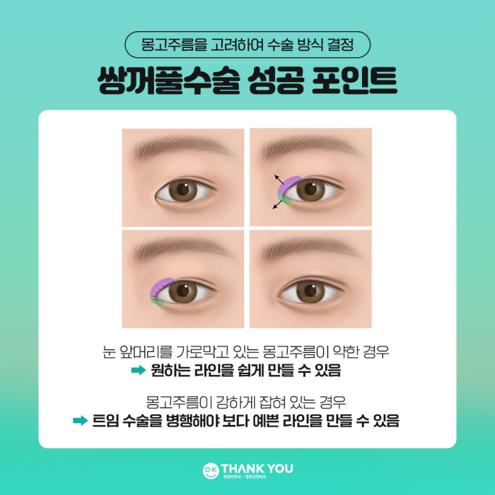 쌍꺼풀수술병원에서 알려주는 눈성형 성공 포인트! 관련 이미지 5
