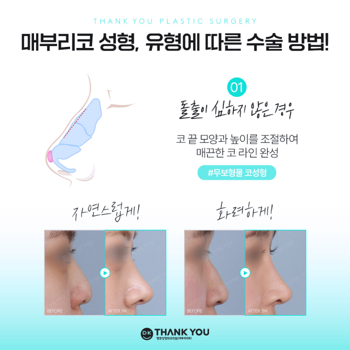 Hump Nose Improvement: Personalized Surgery Is Important! image 4