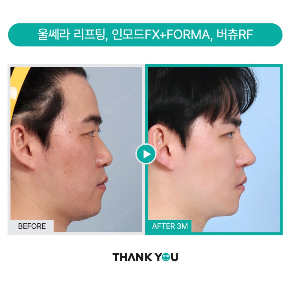 MAKE미남(맥미남) 오덕차장님의 노안 개선&남자 비염코성형 전후 관련 이미지 17