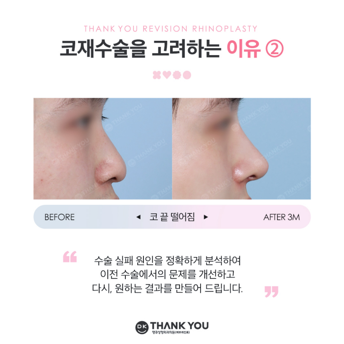 코재수술잘하는병원 땡큐 이벤트✨ 관련 이미지 3