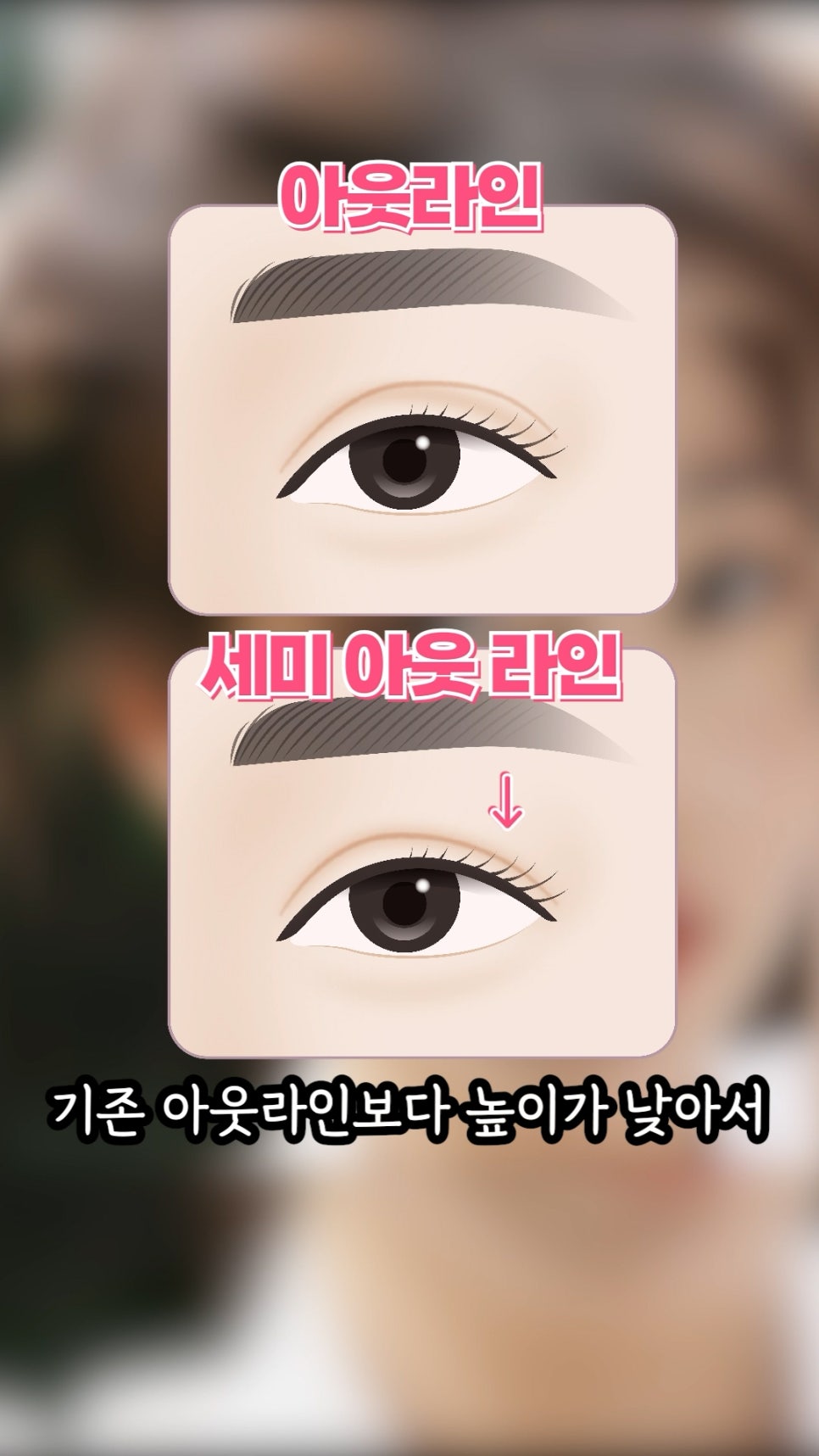 장원영 쌍수, 쌍꺼풀 라인분석 (feat.세미아웃라인) 관련 이미지 9