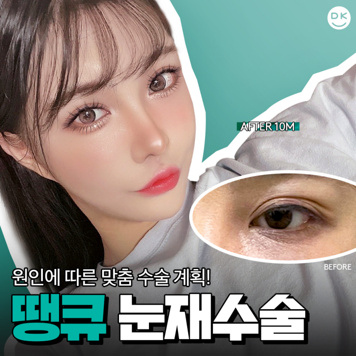 눈재수술전후 만족스러운 차이를 만들고 싶다면?! 관련 이미지 1