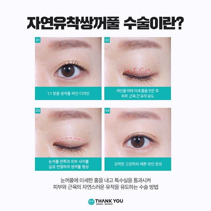 자연유착쌍커풀 수술로 타고난 듯 아름다운 눈 만들기🍀 관련 이미지 2