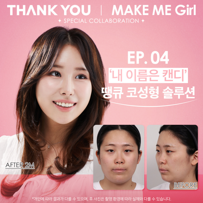 땡큐성형외과, 맥미걸 솔루션! 하비갑개수술 X 미용코, 기능&middot;미용 개선을 동시에! 관련 이미지 1
