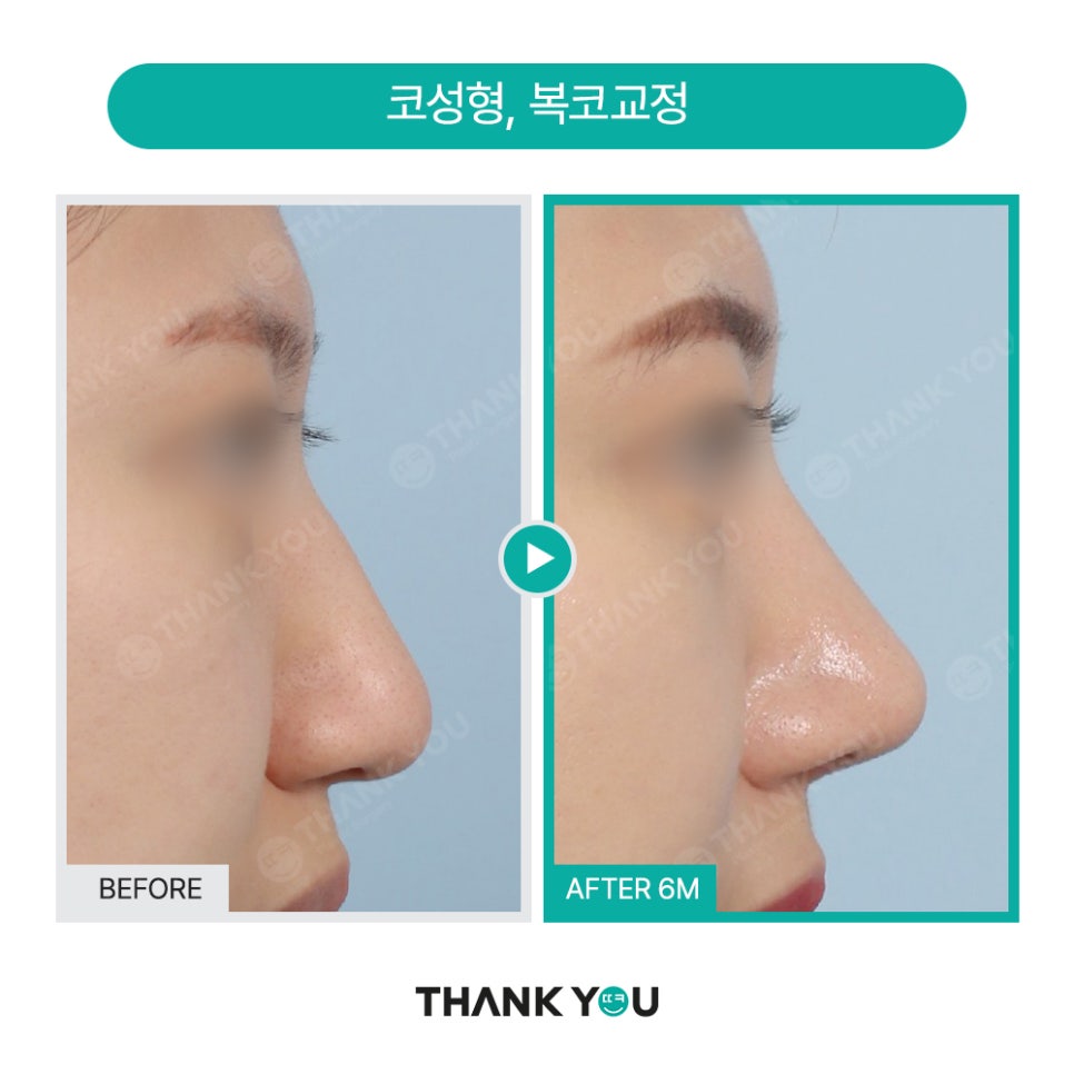 코성형, 비공내리기 수술이란? [콧구멍 잘 보이는 용코 개선] 관련 이미지 7