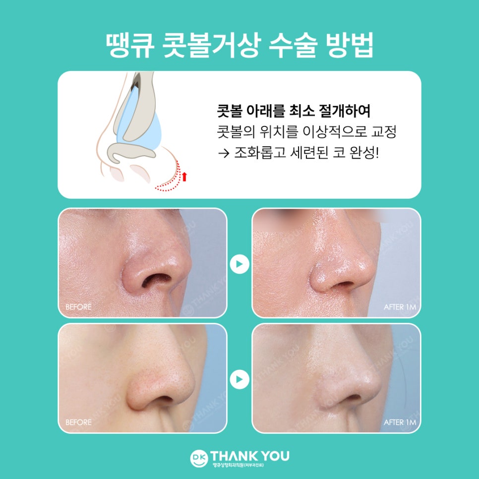 콧볼성형 찾는다면 여기! 땡큐 콧볼축소로 세련된 이미지 완성하기! 관련 이미지 9