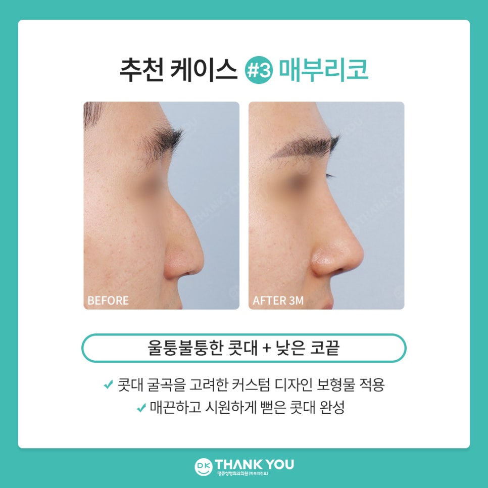 땡큐성형외과 권정우 원장, 코수술재료 관련 이미지 8