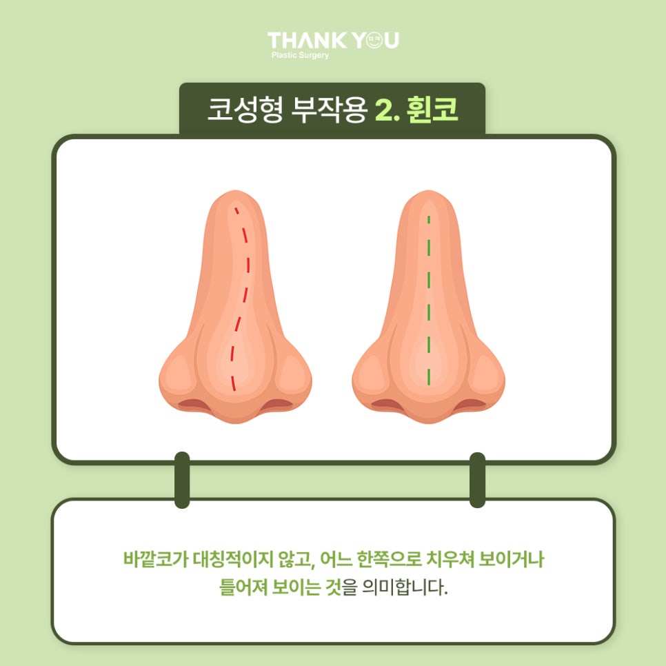코수술, 모양에 따른 디자인이 중요 포인트 관련 이미지 5