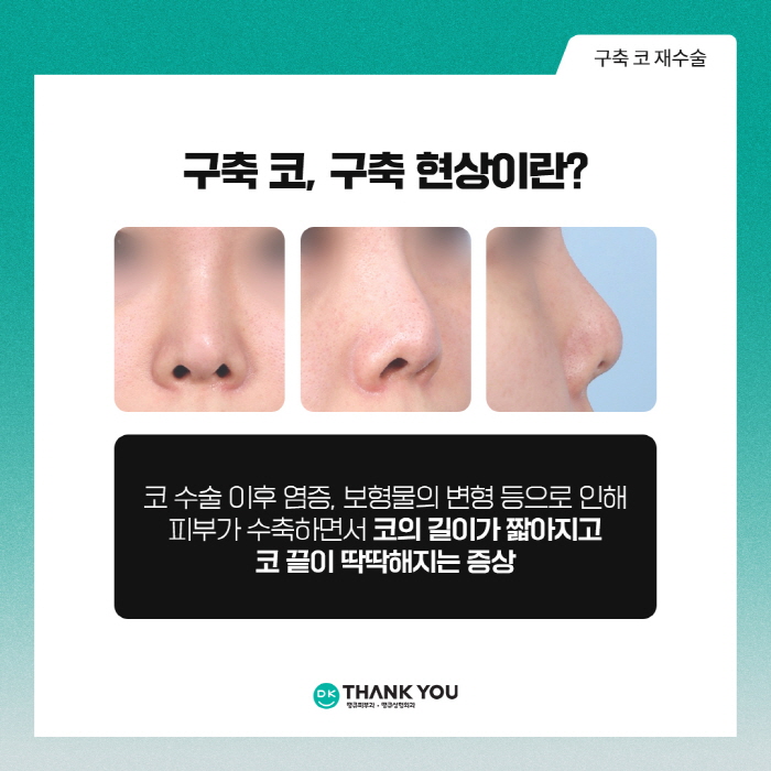 구축코재수술 개인 상태에 따른 계획이 중요해요 관련 이미지 2