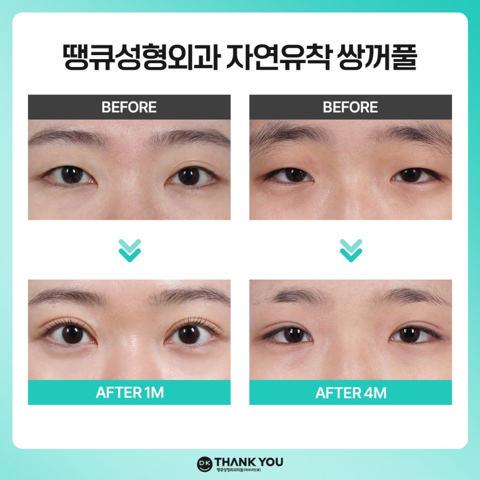 자연유착쌍꺼풀 후기 좋은 곳 땡큐에서 예뻐질 시간💖 관련 이미지 9