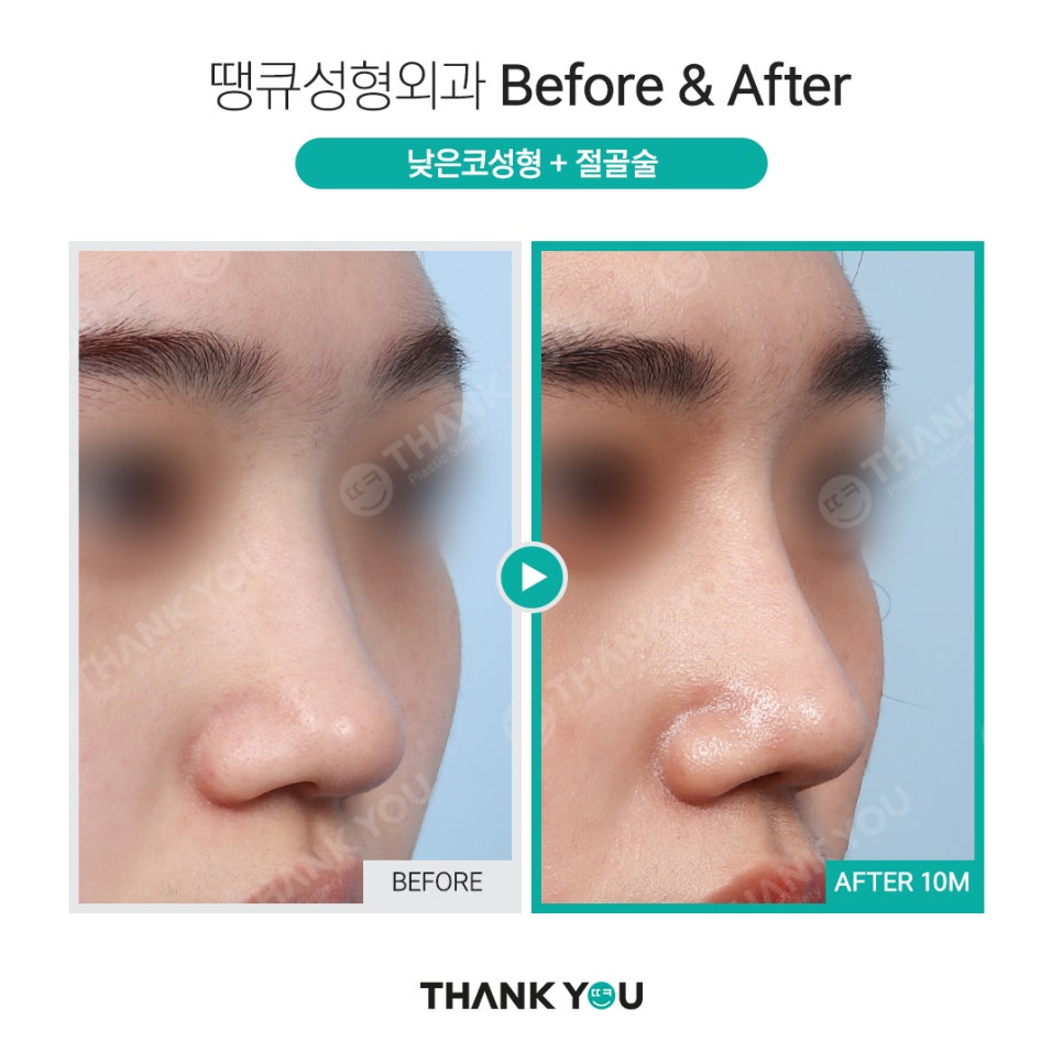 휜코 성형, 휜코 교정 과연 간단할까?(비포&애프터) 관련 이미지 7