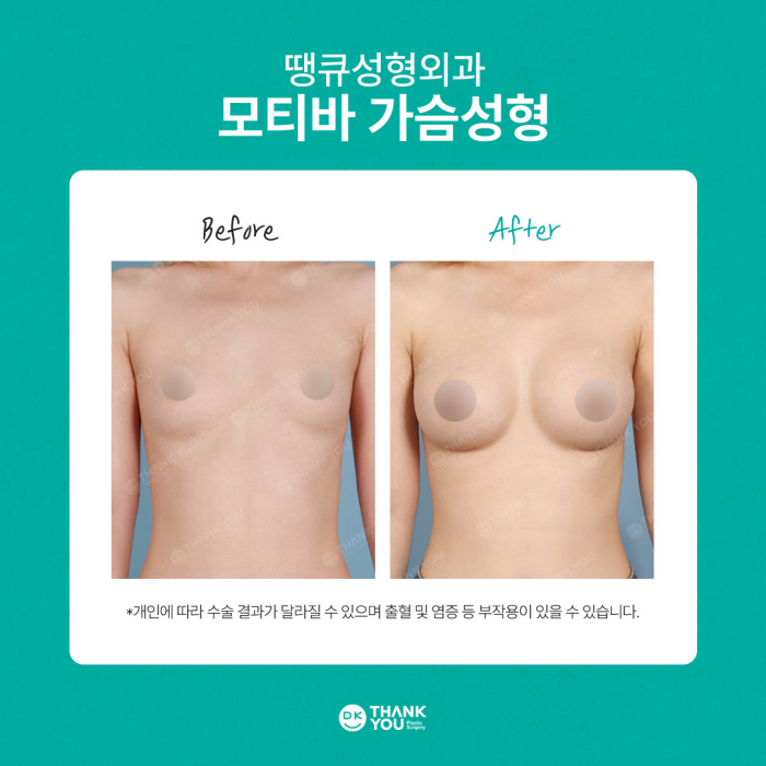 땡큐성형외과 모티바가슴성형 이벤트✨ 관련 이미지 11