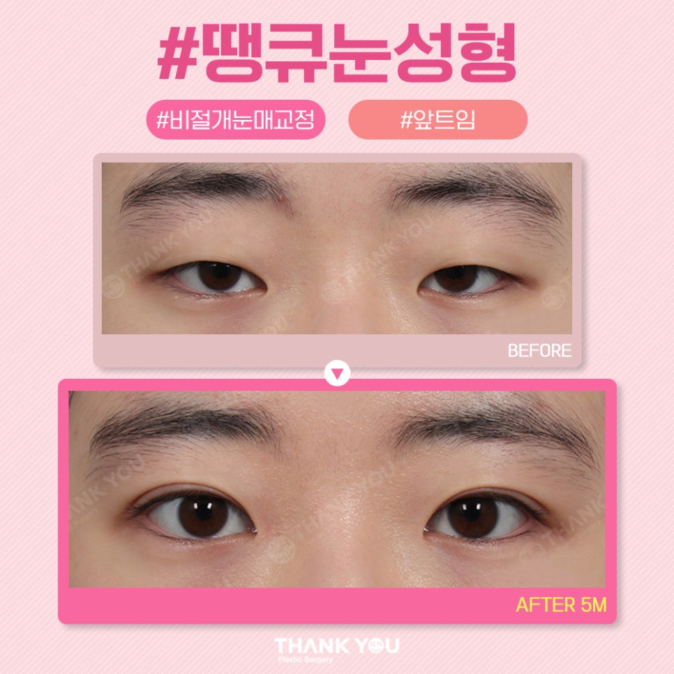 땡큐 쌍꺼풀 전후사진 비교 Before & After 관련 이미지 4
