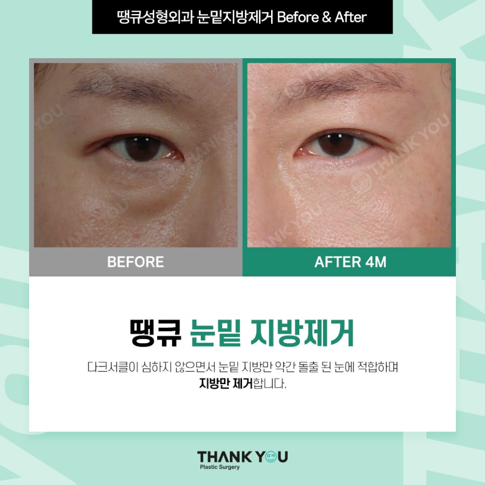 눈밑지 눈밑지방제거, 하안검 차이점은? (눈밑 비포&애프터) 관련 이미지 8