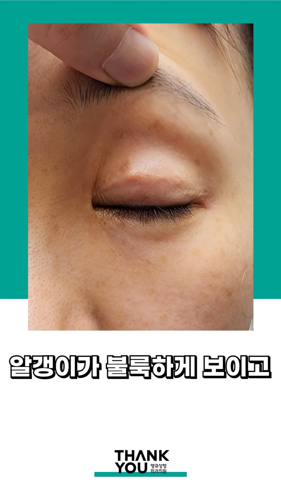 3번 눈재수술? 근데 실제거를 안했다고? 땡큐에서 전부 실제거! 관련 이미지 10
