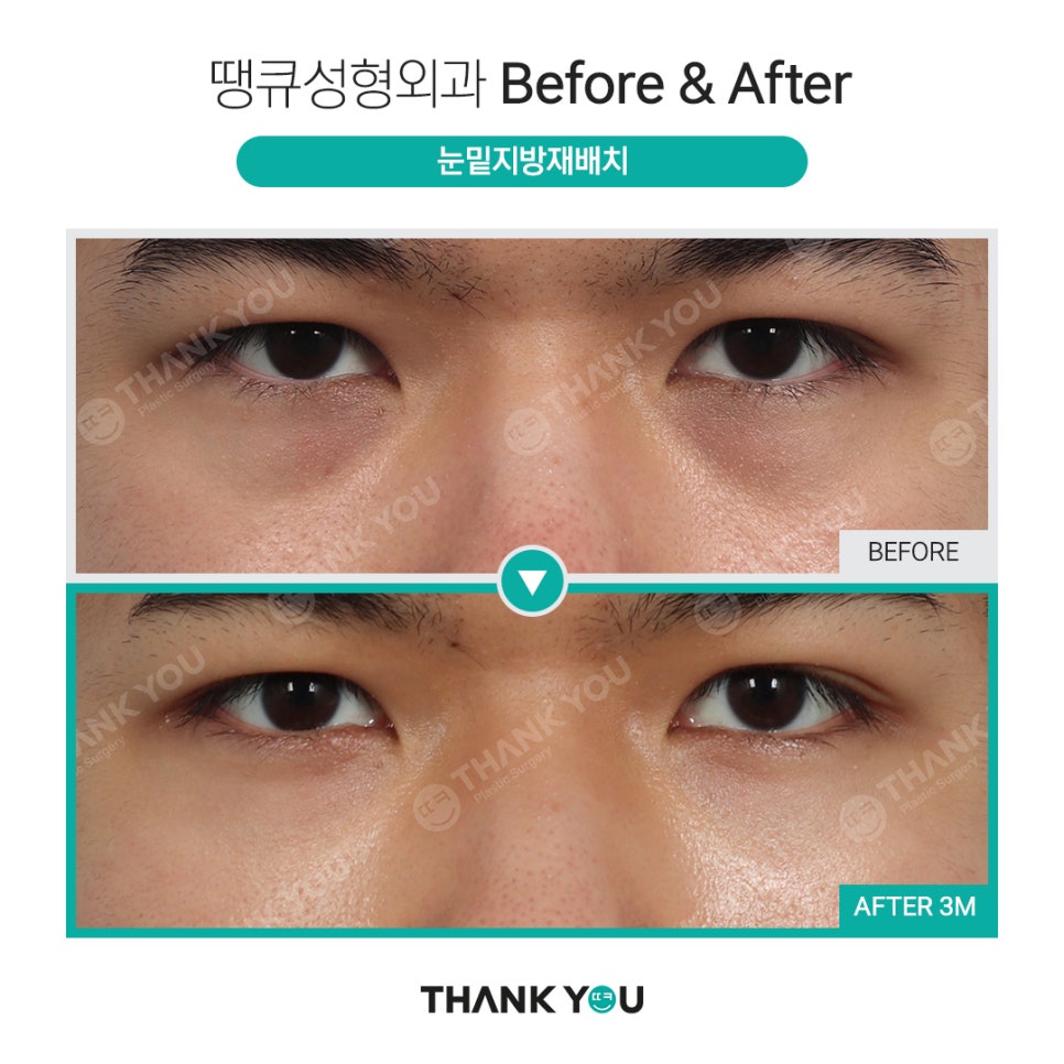 붐 눈밑지방재배치? 남자 눈밑지 전후 (붐, 남창희, 김동현) 관련 이미지 1