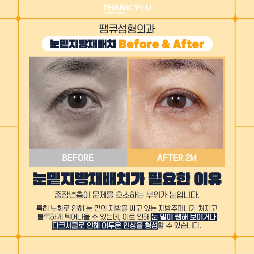 땡큐성형외과 이호준 원장님, 눈밑지방재배치 외고정vs내고정 차이점 관련 이미지 4