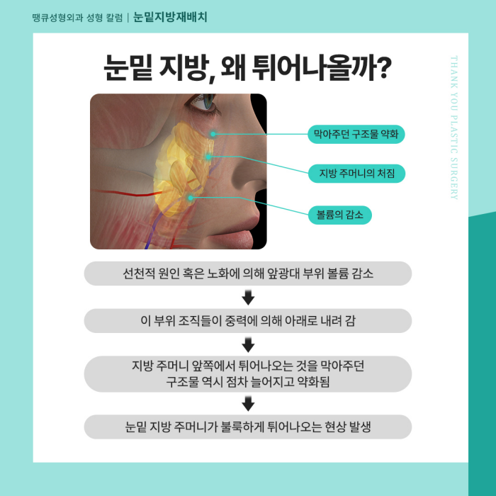 눈밑지 수술 후 얼굴처짐 생길까요? 관련 이미지 2