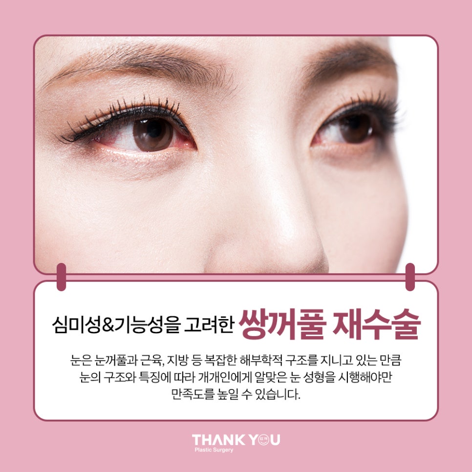 짝눈 교정, 쌍수 재수술 시기 알려드려요 관련 이미지 4