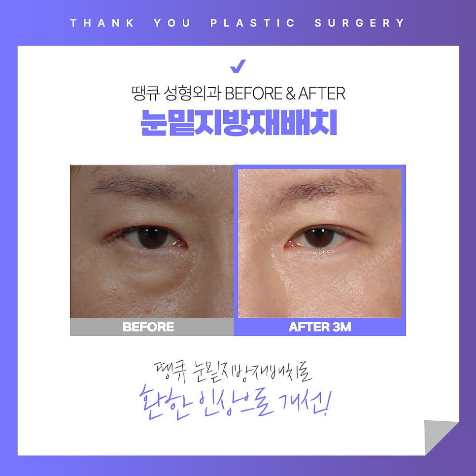 눈밑 불룩? 눈밑지방재배치 수술 후에도 재발할까? 관련 이미지 8