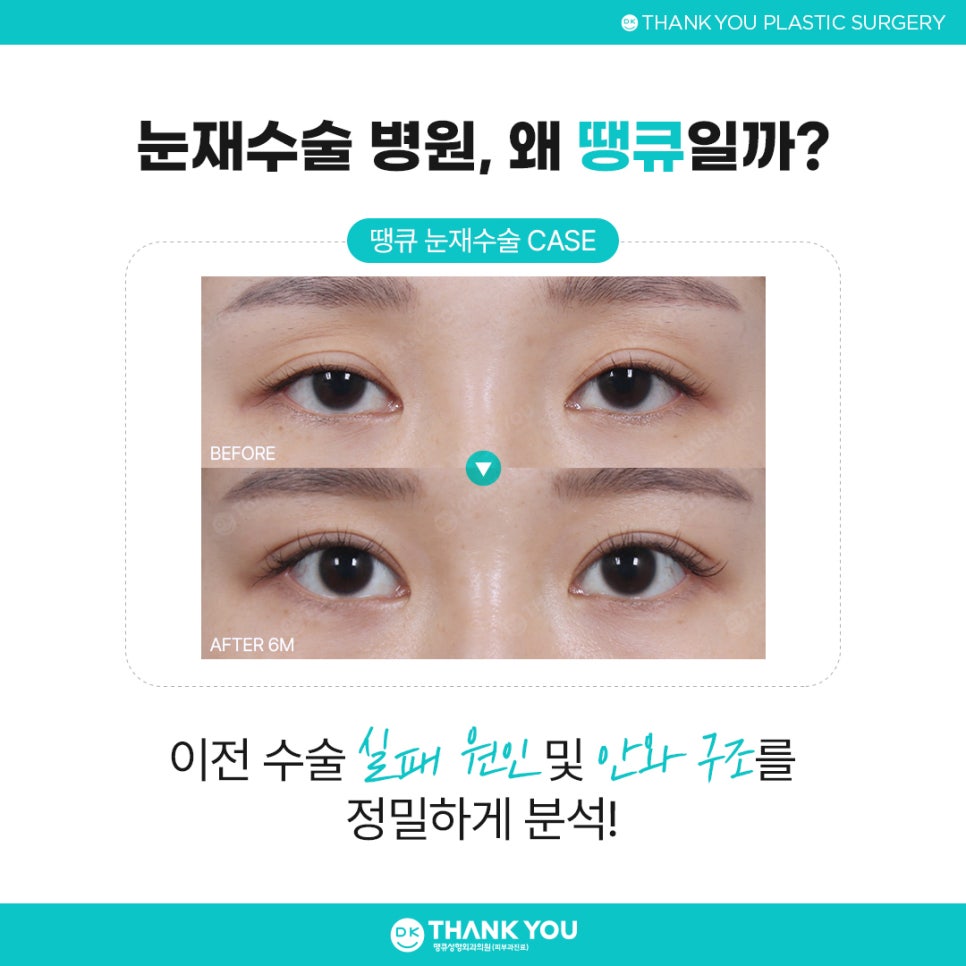 눈재수술병원 잘 고르려면?! 맞춤 수술 여부가 핵심👍 관련 이미지 6