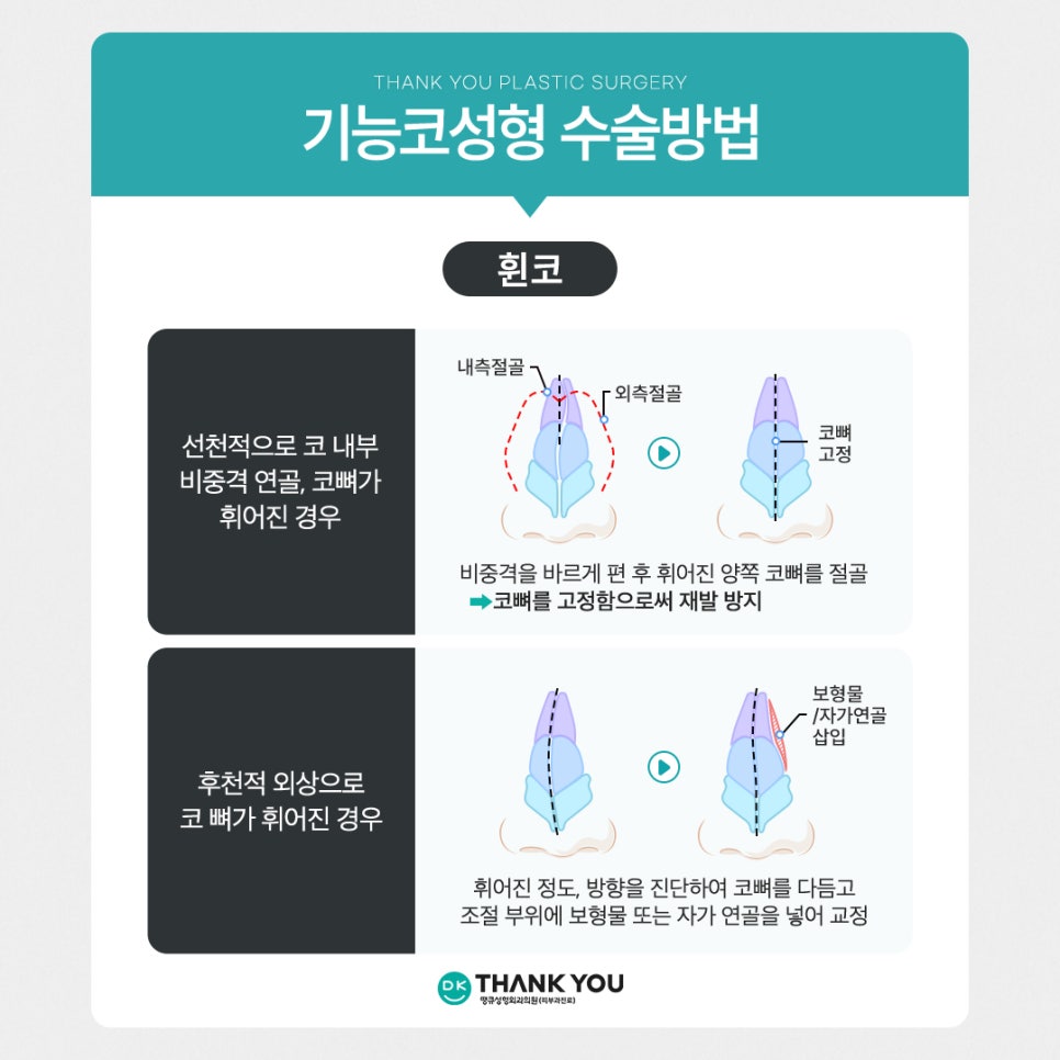 기능코성형, 비염수술코성형 유형별 수술법 알아보기 관련 이미지 7