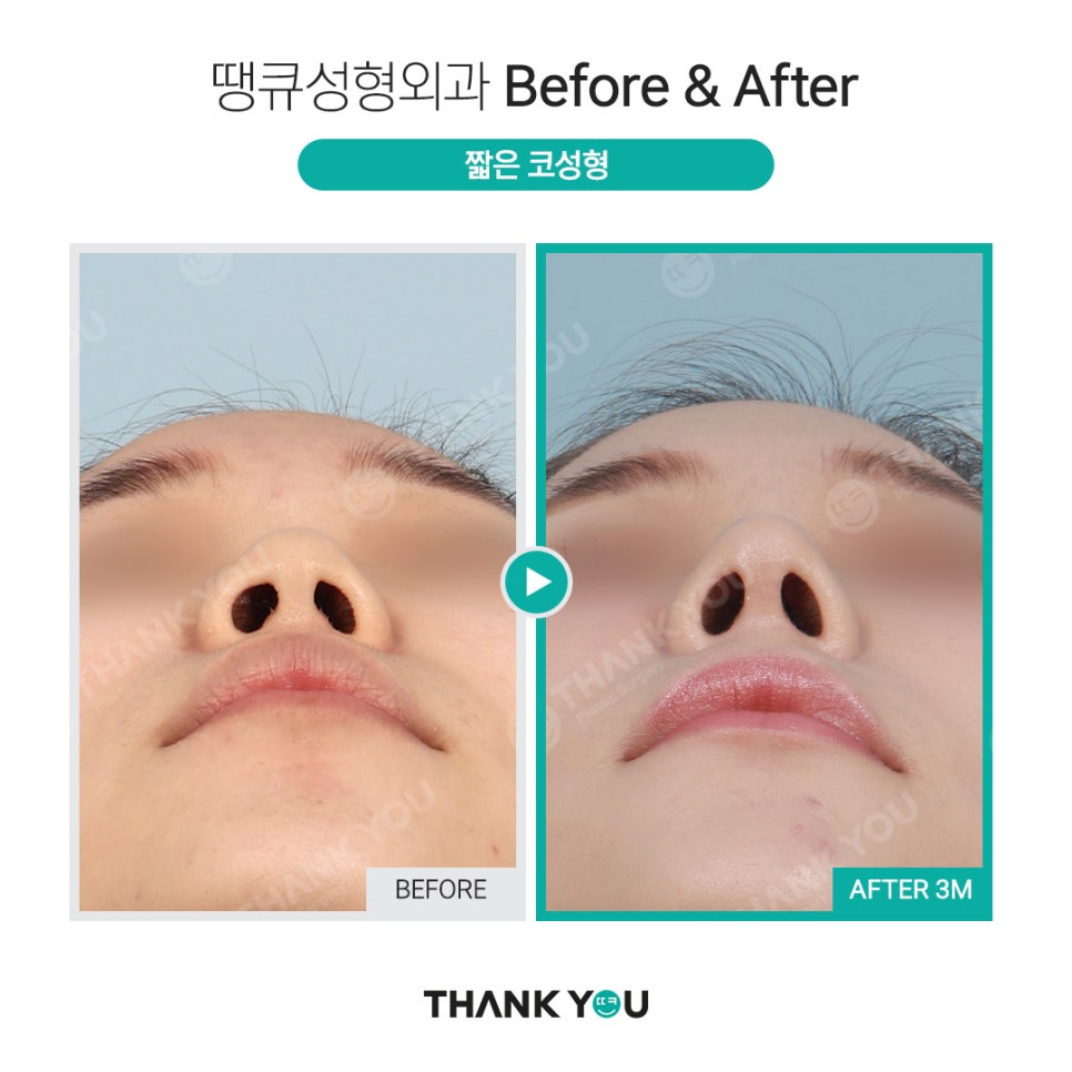 짧은코 교정의 역발상, 짧은코 성형 전후 관련 이미지 5