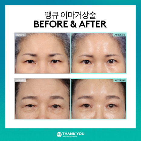 What Are the Effects of a Forehead Lift?[Column by Director Kim Gyu-beom] image 8