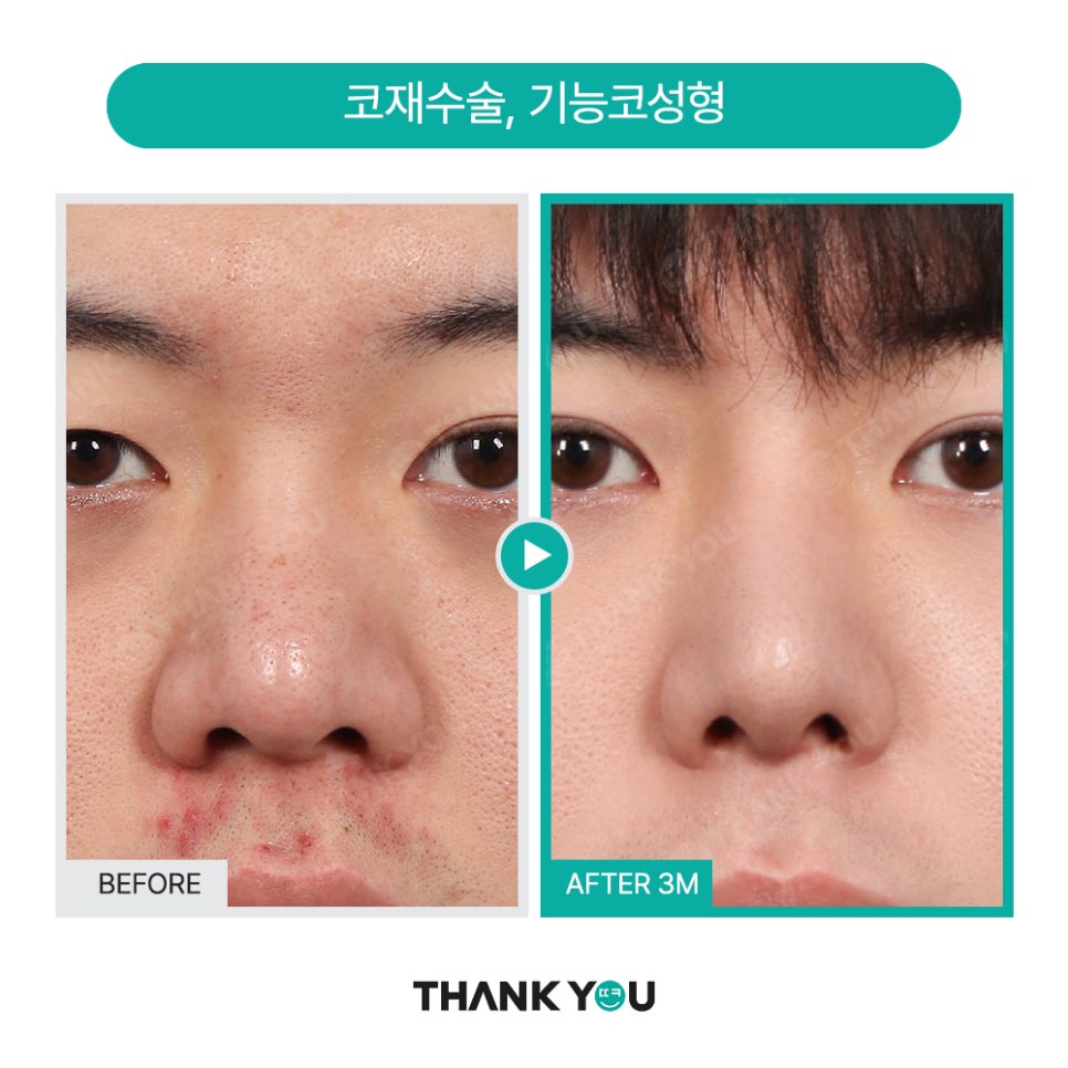 땡큐 맥미남, 뮤지컬배우 남자 복부지방흡입 전후 Check 관련 이미지 11