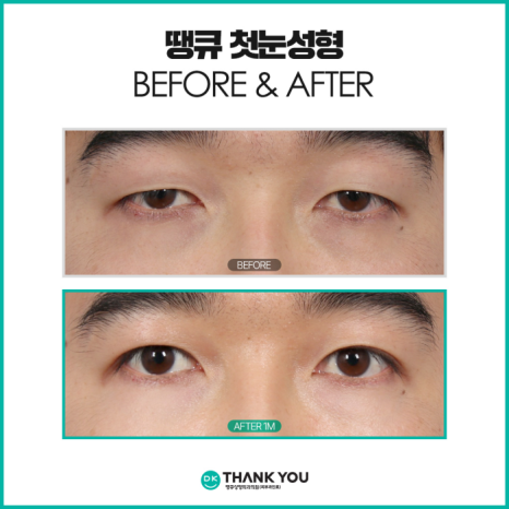 What Should You Check for First-Time Eye Surgery to Achieve Natural and Beautiful Eyes? image 10