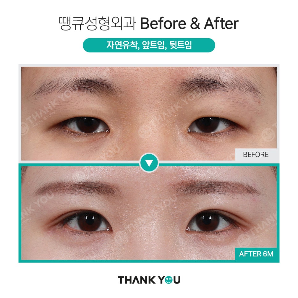 쌍수 뒷트임 (앞트임,밑트임, 듀얼트임 종류) 전후사진 관련 이미지 15