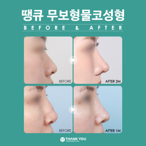 무보형물코성형 재료에 따른 특징을 알아보자! 관련 이미지 7