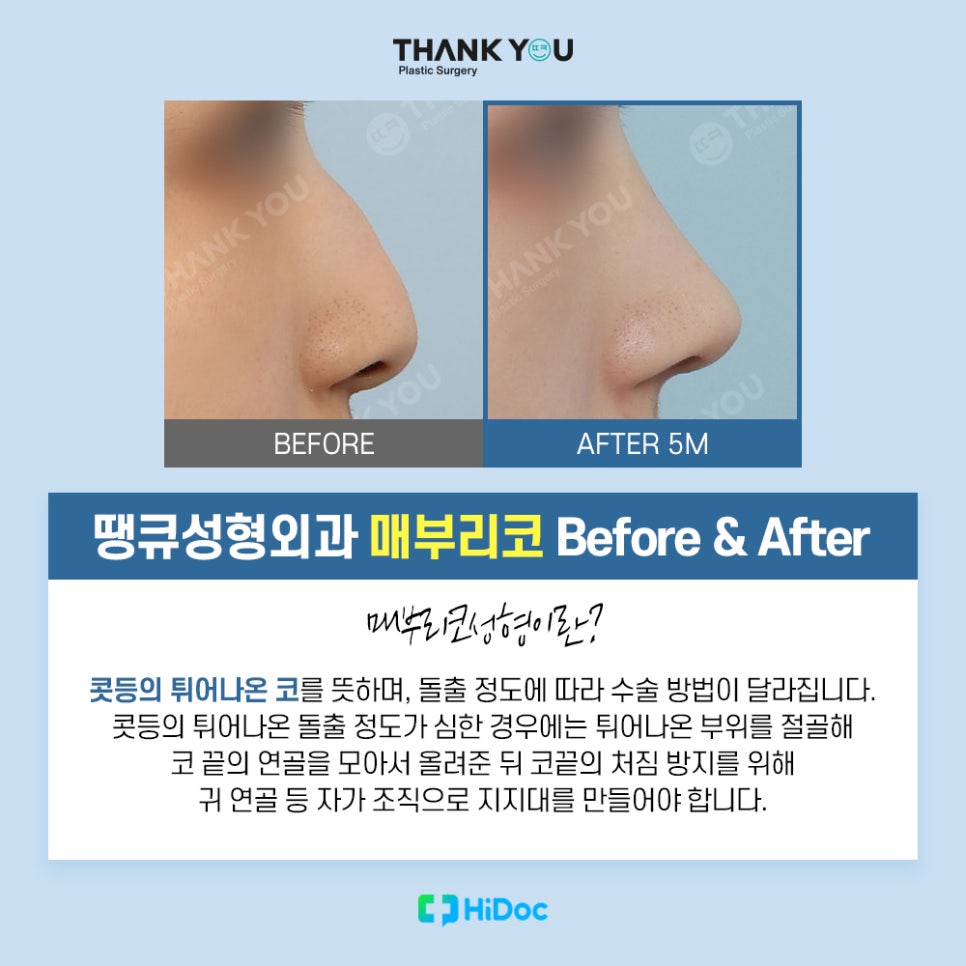 코성형 종류, 보형물과 콧대 라인까지 니즈 체크 관련 이미지 6
