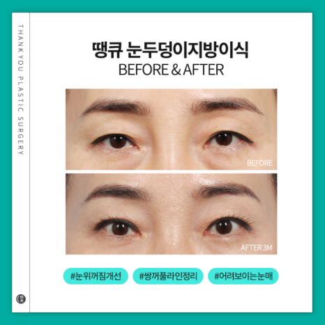 눈두덩이지방이식으로 피곤한 이미지 탈출! 생기있는 눈매 완성! 관련 이미지 11