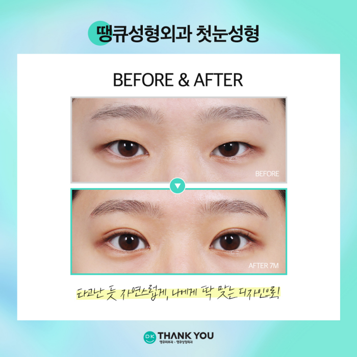첫눈성형 성공을 위해, 눈수술 잘하는 곳 찾는 방법은? 관련 이미지 3