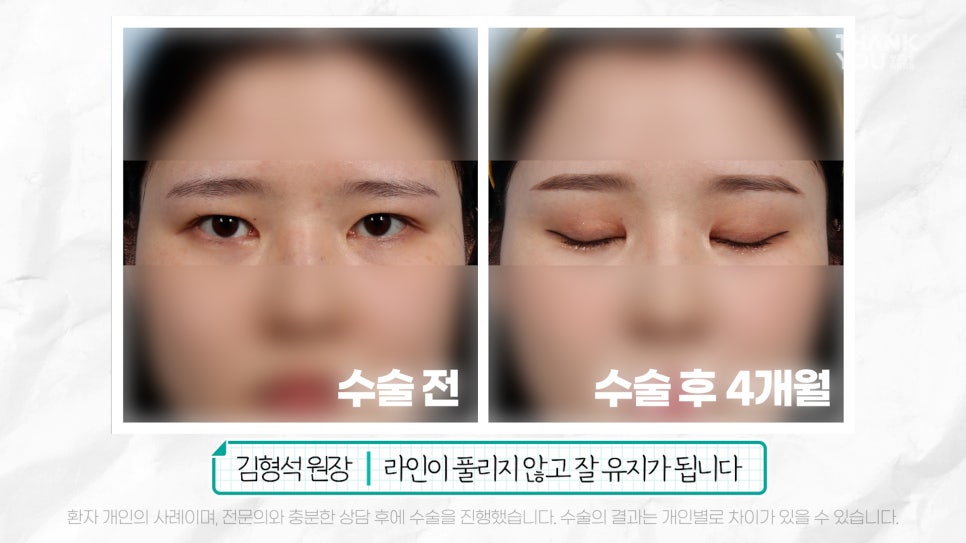 눈재수술 할 때 이마거상 추천하는 이유는? (눈썹올림술 전후) 관련 이미지 21
