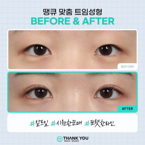 트임성형잘하는곳에서 알려주는 트임 위치별 특징 관련 이미지 4