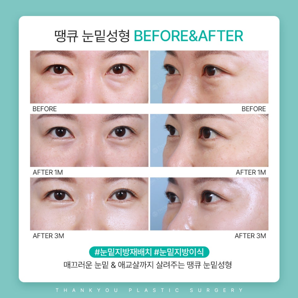 눈밑지방재배치수술만으로 볼륨이 부족하다면? 관련 이미지 6