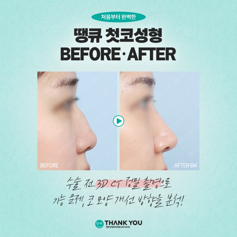 Key Checkpoints You Must Review When Considering Primary Rhinoplasty?! image 8