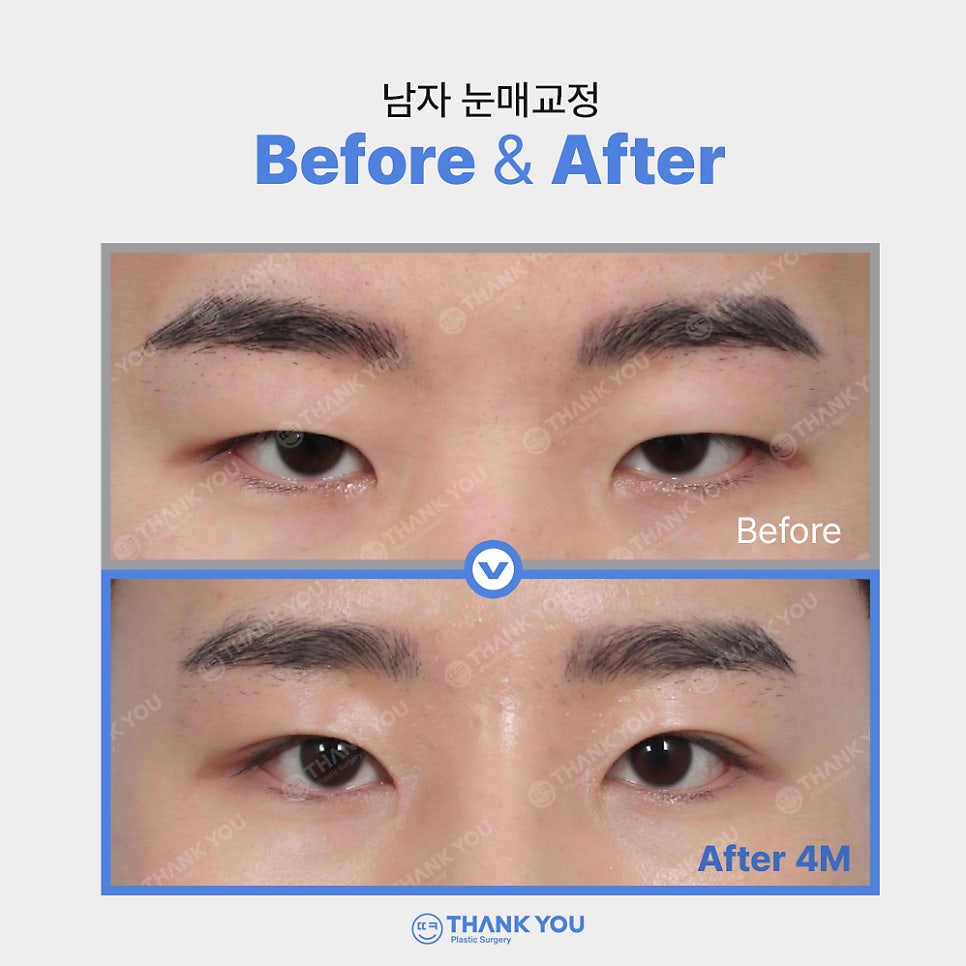 안검하수에 필요한 눈매교정 (ft.전후사진 체크) 관련 이미지 8