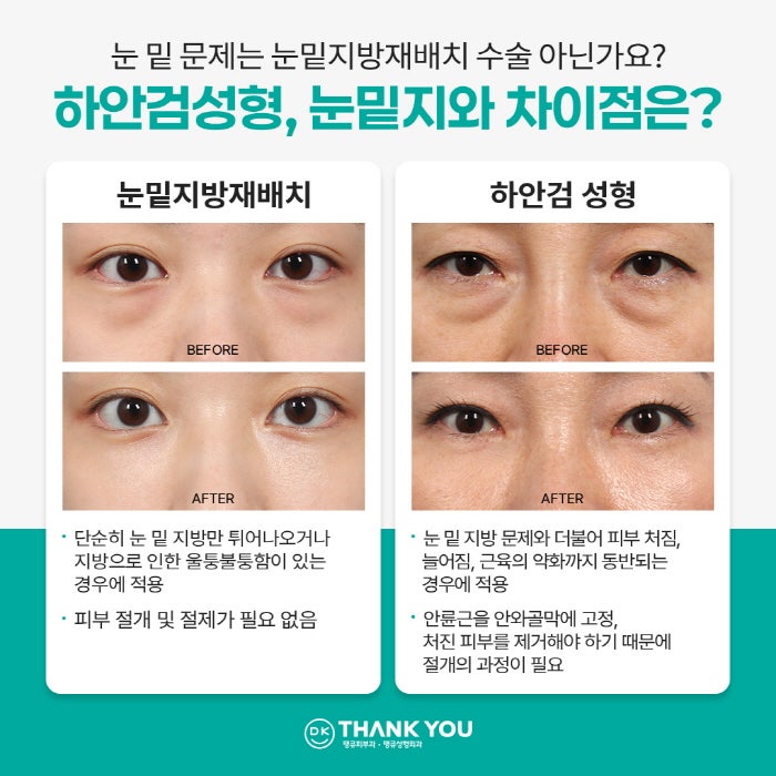 Solving Under-Eye Aging with Lower Blepharoplasty! image 4